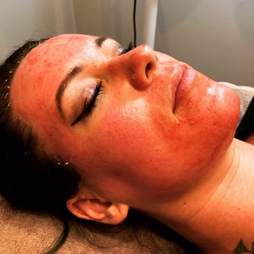 Skin Pen Microneedling w/ PRP (Platelet Rich Plasma) - 1 treatment